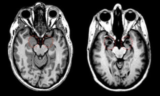 MRI de “X”